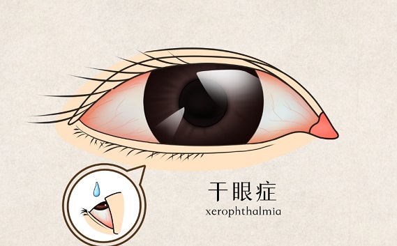 干眼对生活的影响